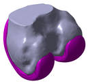 Reconstructed STL model of knee joint replacement 